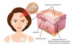 How to diagnose it is vitiligo