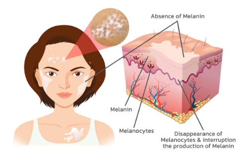 How to diagnose it is vitiligo