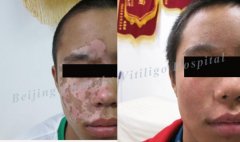 Will all the vitiligo growth you face?