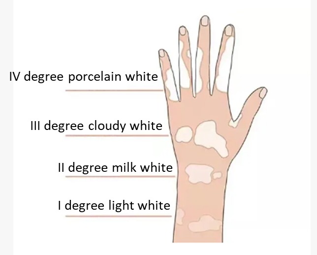 Vitiligo