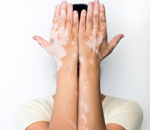 vitiligo causes 