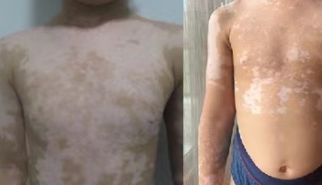 Prevention of Vitiligo