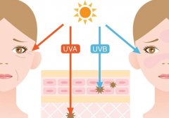 Vitiligo and Sunshine