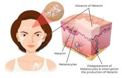 Vitiligo Patient With Hair Depigmentation