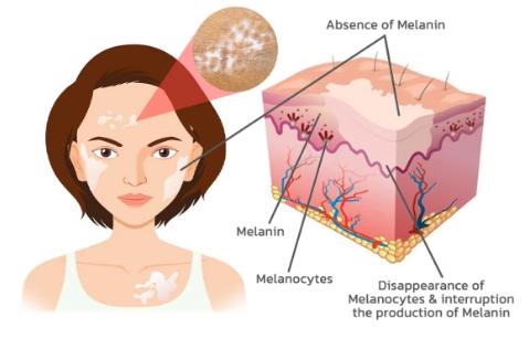 Vitiligo Patients 
