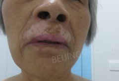 Mucosa Vitiligo