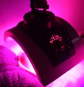 What is the NB-UVB irradiation therapy of vitiligo?