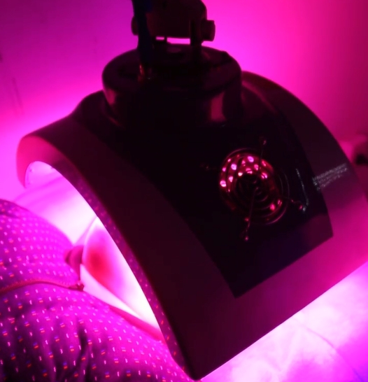 What is the NB-UVB(narrow band ultraviolet b ) irradiation therapy of vitiligo?