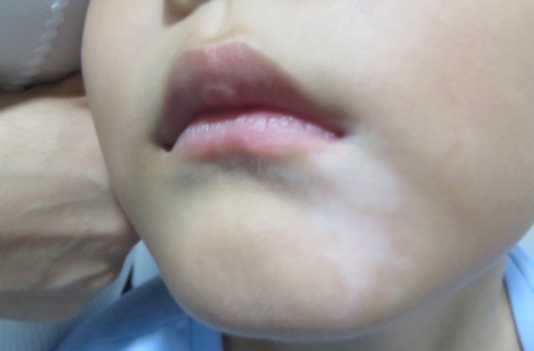 In winter in What kind of situation does vitiligo need consolidation therapy?