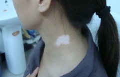 Winter should be a stable period of vitiligo,why does it relapse again ?