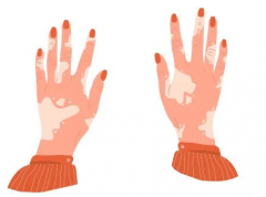 How to distinguish between vitiligo in the progression stage and the stable stage?