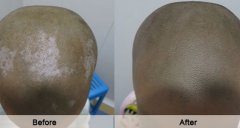 Sanyuan Biochemical Therapy for Vitiligo