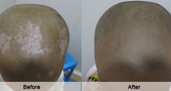 Sanyuan Biochemical Therapy for Vitiligo