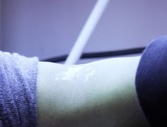  Narrow Band- UVB Therapy for Vitiligo