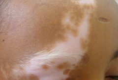 Can Vitiligo Be cured, if the Hair Become White