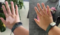 Does Vitiligo Return the Color Means Cure