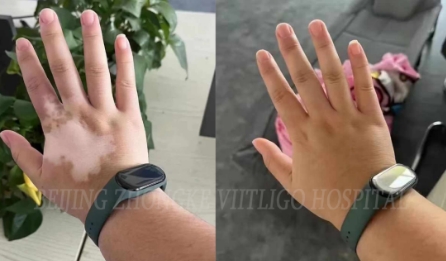 Does Vitiligo Return the Color Means Cure