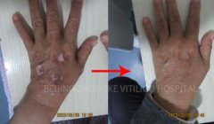 Does Mucosal type Vitiligo Can be Cured