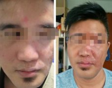 Distinguish White Spot with the Vitiligo