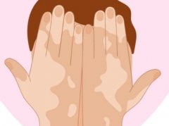 Treat Vitiligo in a Correct Way