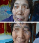 Phototherapy Therapy For vitiligo