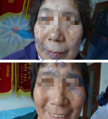 Phototherapy Therapy For vitiligo