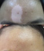 Epidermal Skin Grafting Treatment for vitiligo