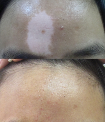 Epidermal Skin Grafting Treatment for vitiligo
