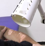 Chinese medicine fumigation to treat vitiligo