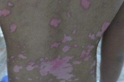 Anti-free Radicals Therapy for Vitiligo