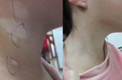 Electric Acupuncture Therapy for Vitiligo