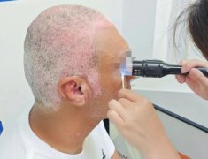 308 Excimer Laser Treatment for Vitiligo
