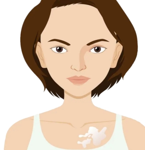 Female Private Vitiligo