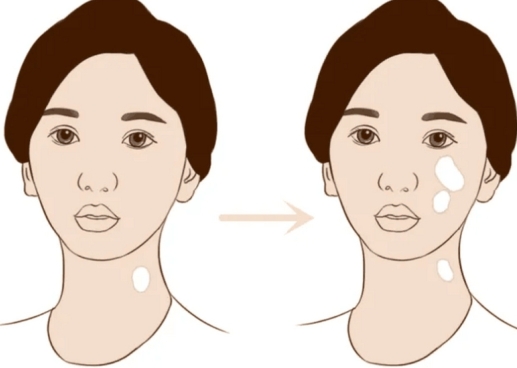 Developing Vitiligo And Stable Vitiligo