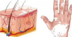 Vitiligo and Nervous