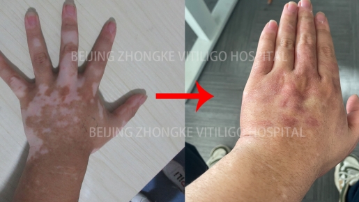 Vitiligo and Endocrine System