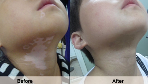 Why Taking Wrong Treatment for Vitiligo Is Worse than No Treatment