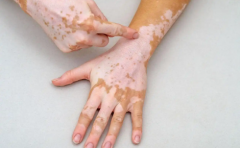 How to Properly Assess the Effectiveness of Vitiligo Treatment