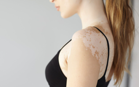 Three Key Points to Note When Using Topical Medications for Vitiligo