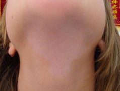 A Swissess Vitiligo Patient Recovery Story