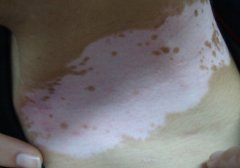Vitiligo Is Easier Happens In Spring Summer