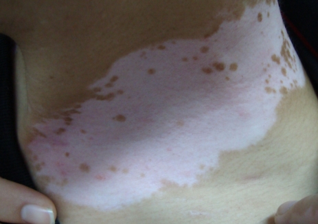 Vitiligo Is Easier Happens In Spring & Summer