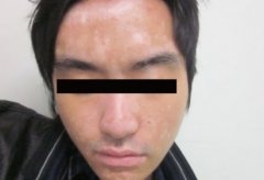 The Teenagers And Vitiligo
