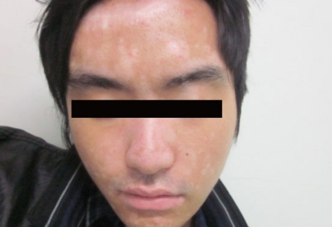 The Teenagers And Vitiligo
