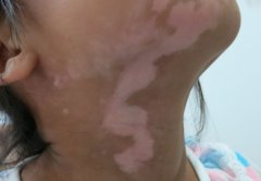 The formation of melanin-- Vitiligo Knowledge