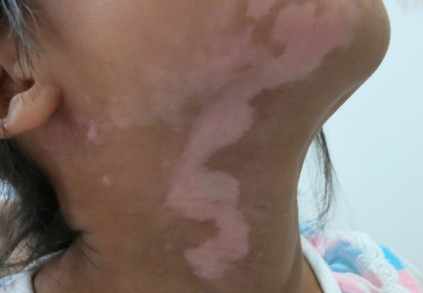 vitiligo 