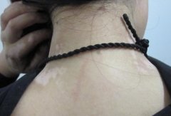 Who Are the High-Risk Population of Vitiligo?