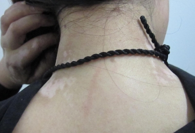 Who Are the High-Risk Population of Vitiligo?