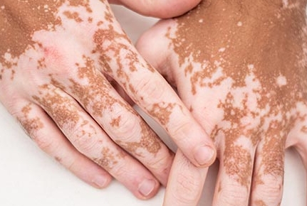 What Are The Symptoms of Vitiligo?