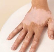 The Regular Acknowledge of Vitiligo —— Part V
